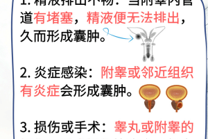 右侧附睾囊肿