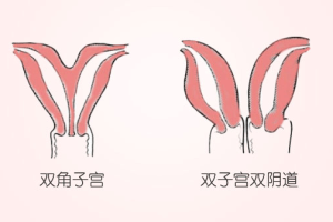 双角子宫