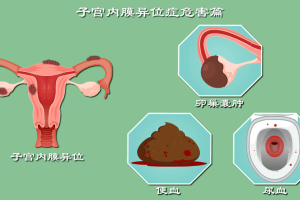 子宫内膜异位症