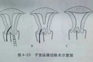 纵隔子宫