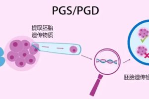 第三代试管婴儿(PGD)