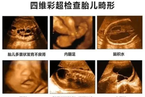 四维彩超