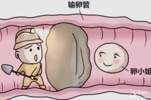 什么是输卵管阻塞？有哪些症状呢？白带异常是其一