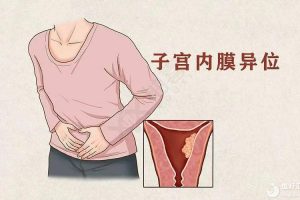 子宫内膜异位症为什么会引发不孕？